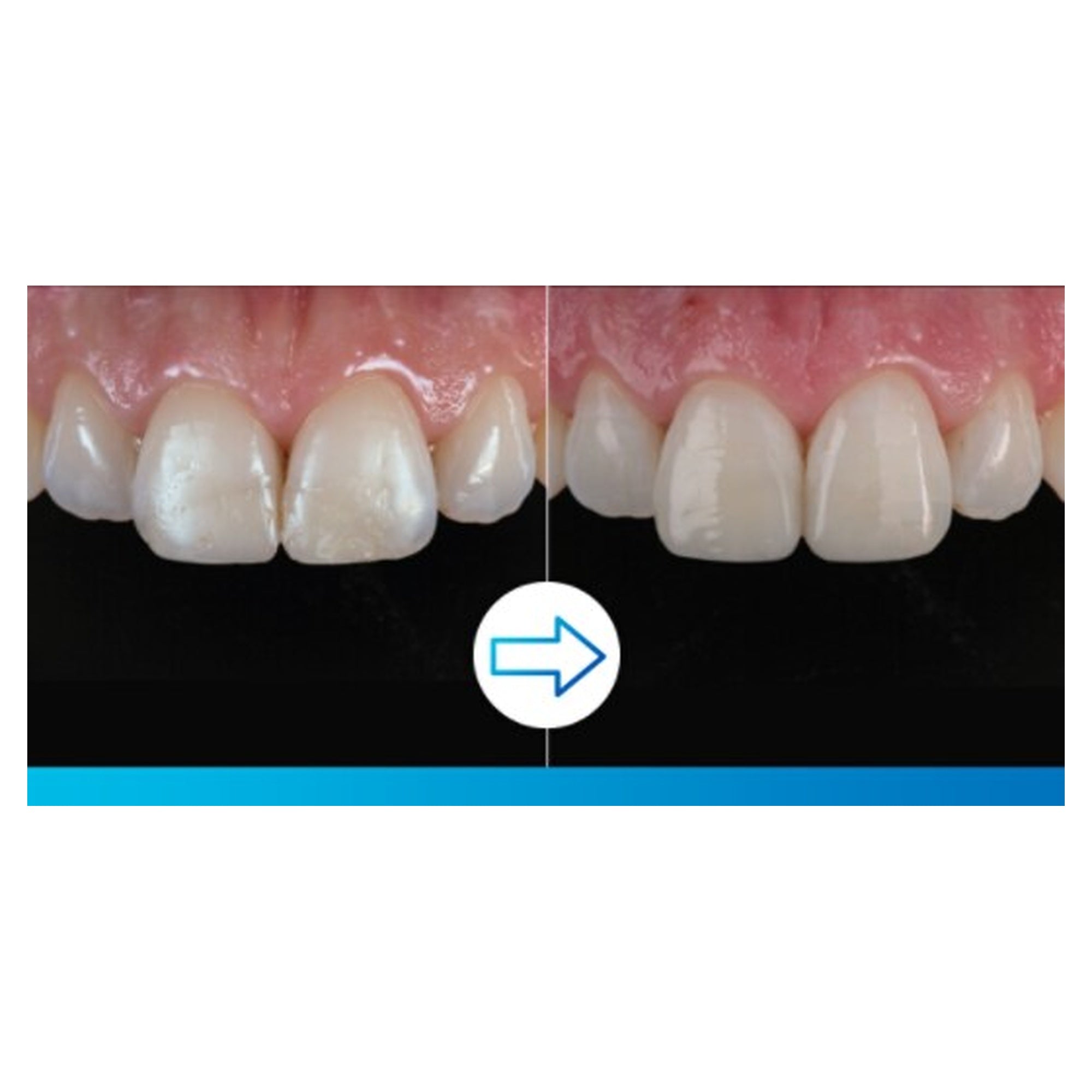 3M Filtek Easy Match Universal Restorative Unidose | EBIKO Dental - alternate view